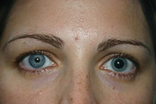 fixed dilated pupil without eom involment