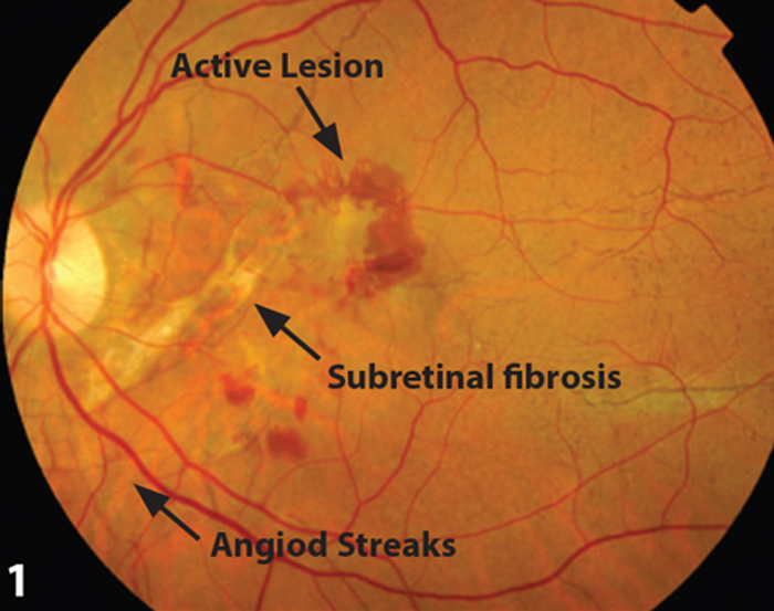 A Patient Report Of Pseudoxanthoma Elasticum Angioid Streaks And Choroidal Neovascularisation 5336