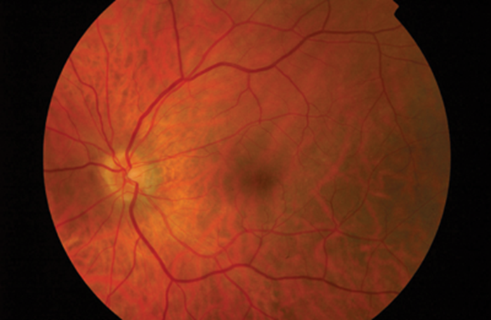 Macula re-attachment following intravitreal ranibizumab in ...