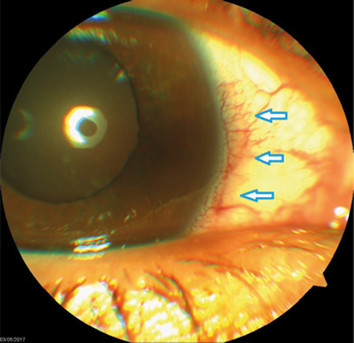 A stepbystep approach to the diagnosis and management of