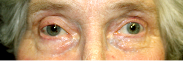 Third Nerve Palsy Following Cataract Surgery With Sub Tenon S Anaesthesia Eye News