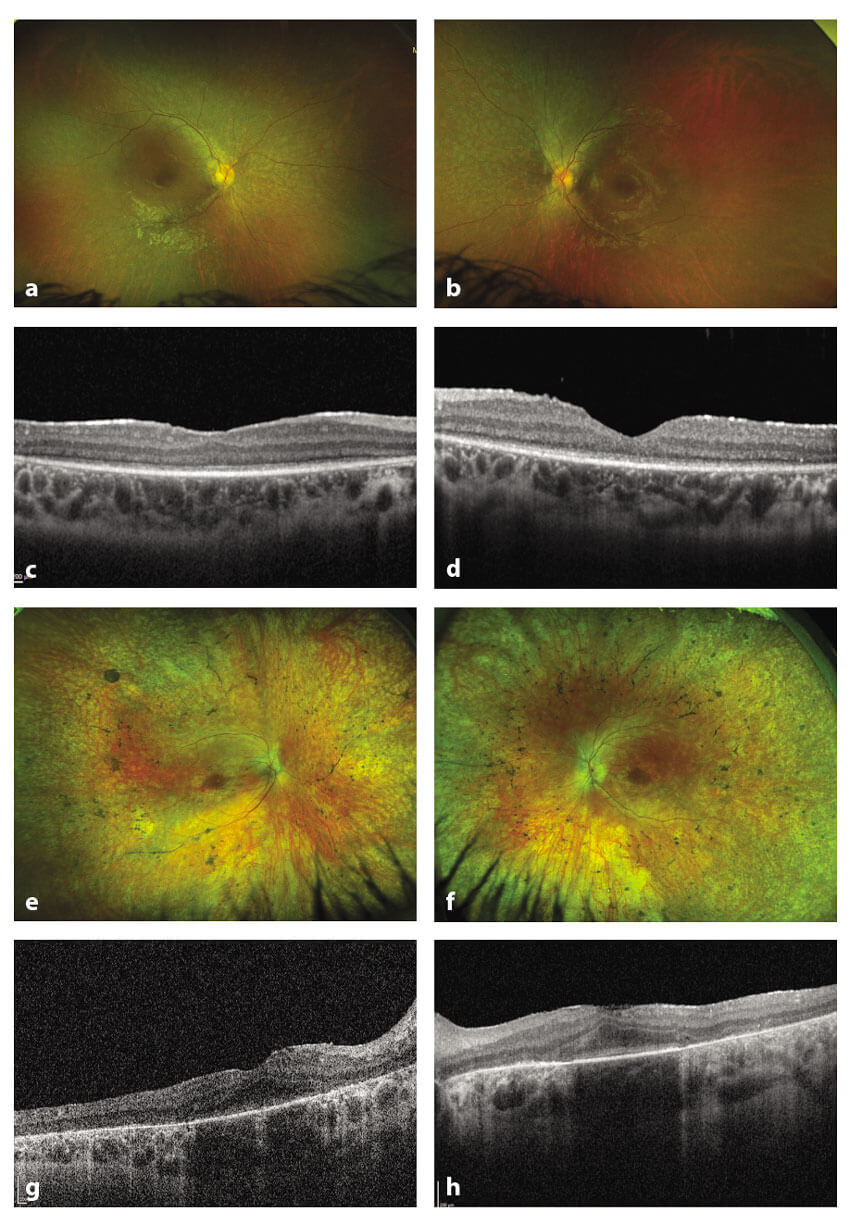 Gene Therapy For Inherited Retinal Disease: The Manchester Ocular Gene ...