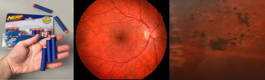 Nerf Guns and Eye Injuries  Eye & Vision Care Optometric Group