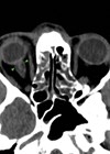 CT head showing dilatation of optic nerve sheath.