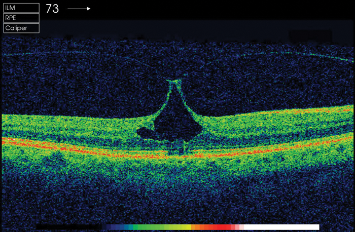 Macular Holes: A Brief Review | Eye News