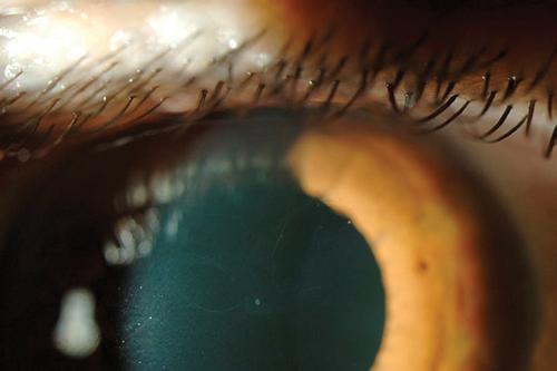 Corneal Dystrophies Simplified | Eye News