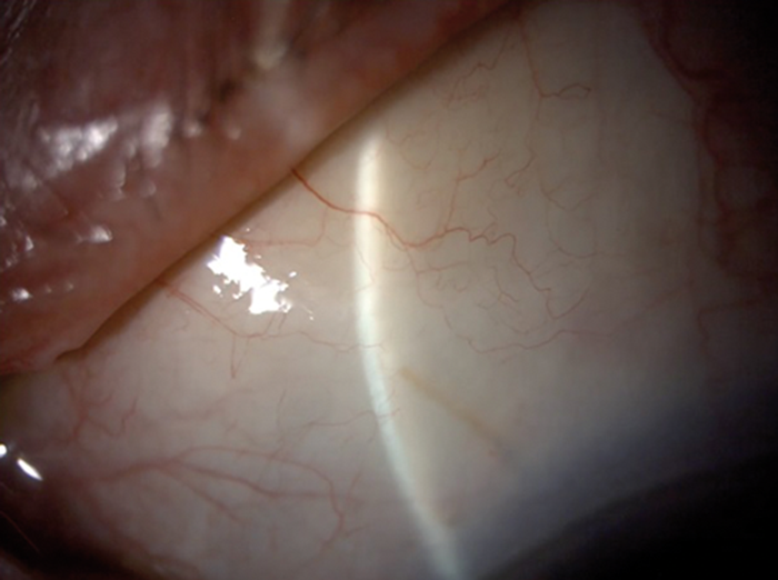 A closer look at the new wave of glaucoma surgery – radical or old ...