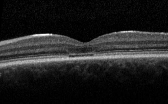 An update on inherited retinal disorders (part 1) – overview and ...