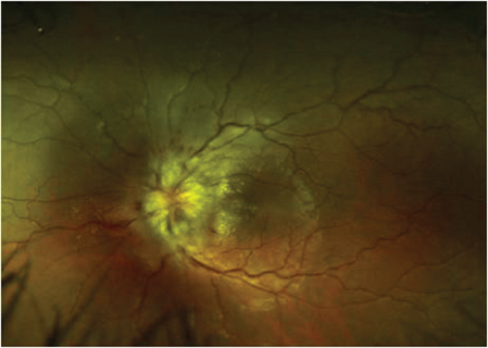 Typical And Atypical Optic Neuritis Diagnosis And Initial Management Eye News 