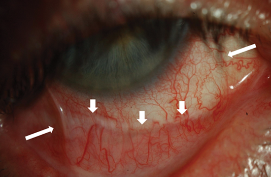 The five features found most commonly in the human iris. The arrows are