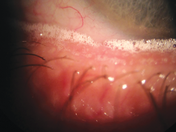 Optimising the ocular surface by managing meibomian gland dysfunction ...